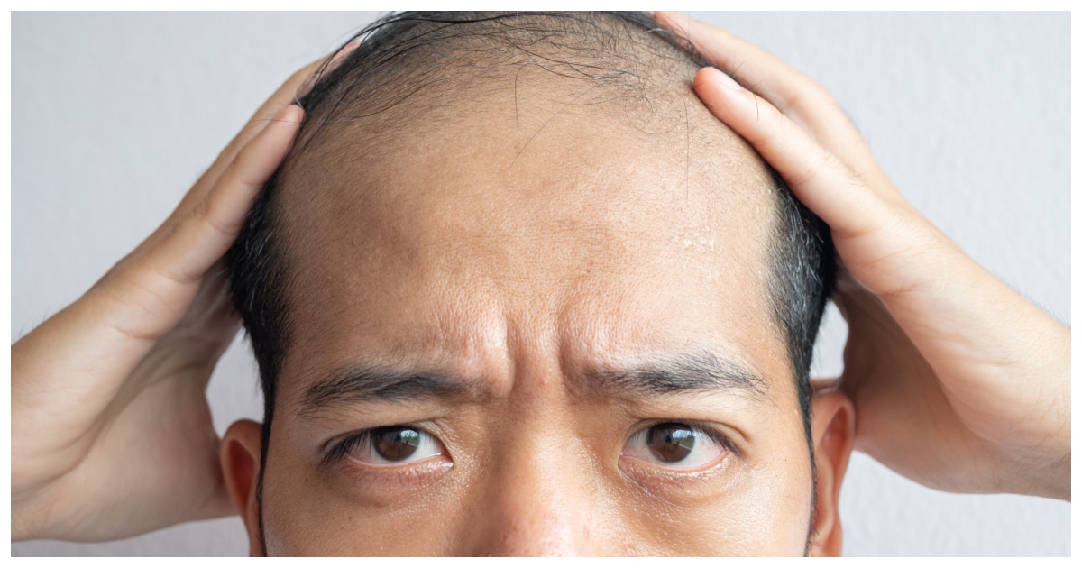 পুরুষদের টাক পড়ার সমস্যার সমাধান হতে যাচ্ছে। ছবি: দ্য ন্যাশনাল